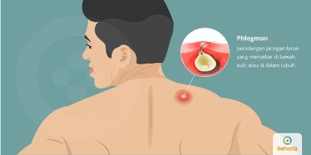 phlegmon-1552641803