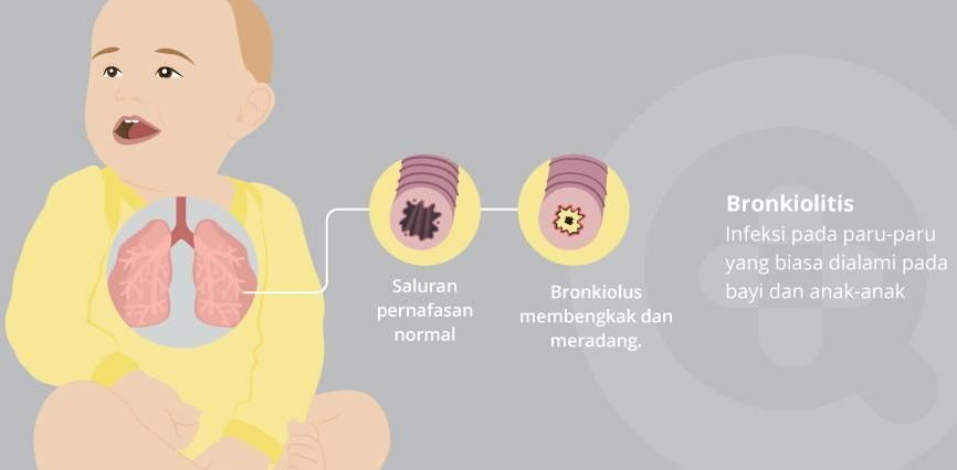 bronkiolitis-1560754059