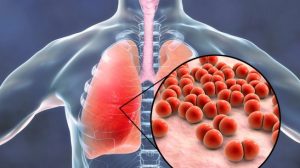 23606-ilustrasi-pneumonia-radang-paru-paru-penyakit-paru-paru-shutterstock