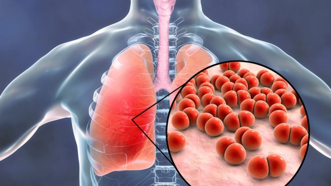 23606-ilustrasi-pneumonia-radang-paru-paru-penyakit-paru-paru-shutterstock