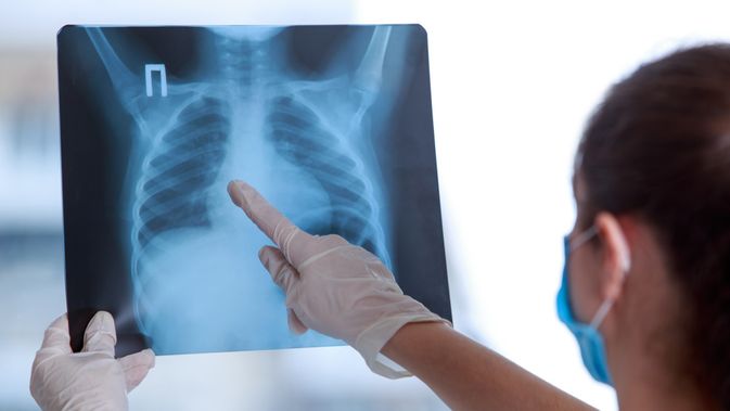 025065000_1599552225-5-Tipe-Pneumonia-yang-Harus-Diketahui-shutterstock_1704822400