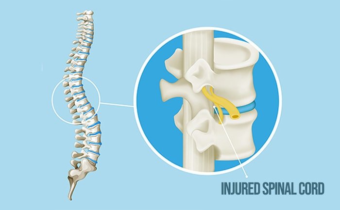 Spinal Cord Injury-1-min