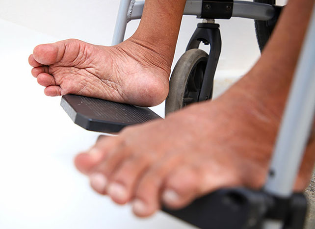 Wabah-Polio-Masih-Berlangsung-Foto-Shutterstock